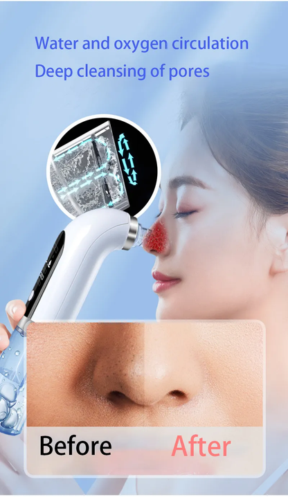 Blackhead Removal Vacuum for Radiant Skin